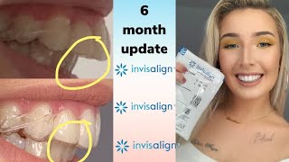 Invisalign Overbite Correction  6 Month UPDATE with before and after pics [upl. by Theurich988]