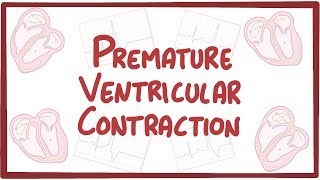 Premature Ventricular Contraction  causes symptoms diagnosis treatment pathology [upl. by Atined]