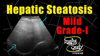 Mild Hepatic Steatosis  GradeI Fatty Liver  Ultrasound  Case 230 [upl. by Erdeid]