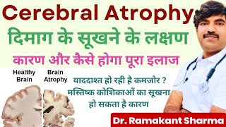 मस्तिष्क कोशिकाओं का सूखना  Cerebral Atrophy  याददास्त में कमी आना [upl. by Ennairam]