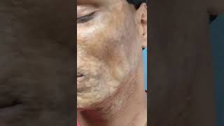 Morphea  Scleroderma  एक साधारण बीमारी भी इलाज के अभाव में काफी ख़तरनाक रूप ले सकती है  morphea [upl. by Tnomel]