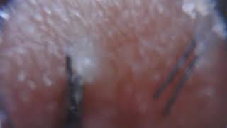 INFECTED INGROWN HAIR REMOVED 32 [upl. by Leba]