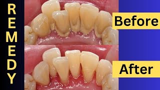 How To Remove Dental Plaques Naturally At Home [upl. by Nauq]