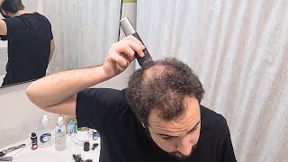 BALDING In My 20s  Shaving My Head amp Accepting Going Bald [upl. by Negem]