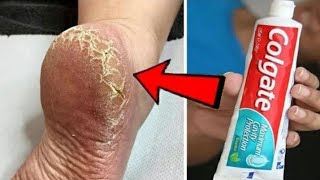 Eliminate Cracked Heels and Get White Smooth Feet  Cracked Heels Home Remedy [upl. by Mohandas]