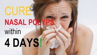 Nasal Polyps Natural Treatment  How to Get Rid of Nasal Polyps at Home [upl. by Kcirrad]