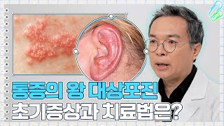 이게 대상포진 초기증상 72시간 골든타임이 중요한 이유｜건강노트 [upl. by Gnuhp]