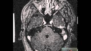 Mastoiditis Brain Abscess DISCUSSION [upl. by Elyag]