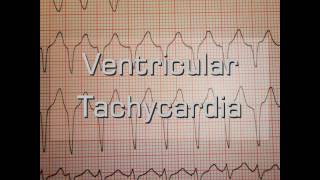 Ventricular Tachycardia [upl. by Kat623]