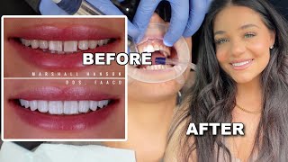 I GOT VENEERS My Experience 🦷 Without shaving my natural teeth  Blissfulbrii [upl. by Tema]