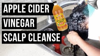 APPLE CIDER VINEGAR SCALP CLEANSE  See How it works 💪 [upl. by Rednas]