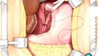 Malpractice Medical Hernia  Hiatal Open Repair Surgery 3 [upl. by Aztiram300]