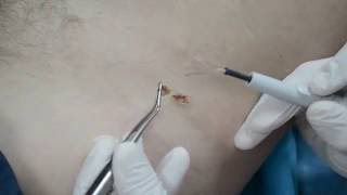 Papillomas removal by highfrequency electrosurgery [upl. by Ecienaj]