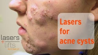 Treating acne cysts [upl. by Duncan]