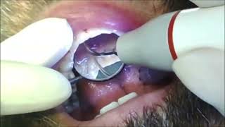 42 Yo Male’s teeth cleaning  Scaling by dental hygienist [upl. by Carilla]