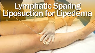 Lipedema Liposuction Surgery  Lymphatic Sparing  Expert Dr Thomas Su  ArtLipo [upl. by Lola]