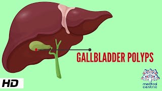 Gallbladder Polyp Causes Signs and Symptoms Diagnosis and Treatment [upl. by Eel]