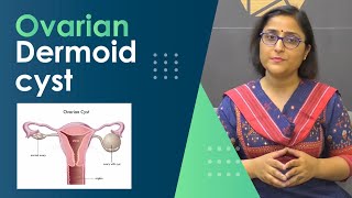 Ovarian dermoid cyst  when to operate अंडेदानी में डरमॉड सिस्ट  क्या करें [upl. by Imugem]