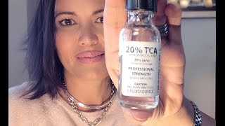 20 TCA FACIAL PEEL  STEP BY STEP TUTORIAL [upl. by Dnaleel]