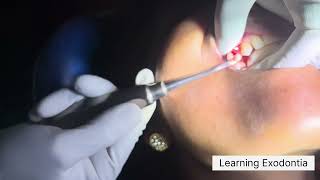 Maxillary first premolar extraction  upper first molar extraction dentist trending youtube [upl. by Annay]