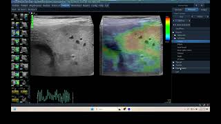 IQ 310 LIVER HEPATOMA ULTRASOUND ECHOPAC ANALYSIS ELASTOGRAPHY [upl. by Lidah]