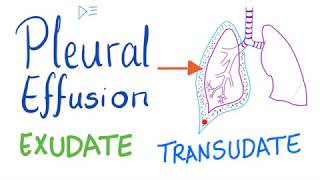 Pleural Effusion  Transudate or Exudate  Causes and Liddle’s Criteria Pulmonary Medicine Playlist [upl. by Onabru]