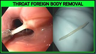 Fish Bone in the Throat II Endoscopic Foreign Body Removal BDENDOSCOPY [upl. by Ynalem]