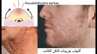 pseudofolliculitis barbae التهاب جريبات الذقن الكاذب [upl. by Arman948]