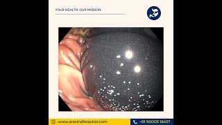 orbera Intra gastric balloon placement [upl. by Teews]