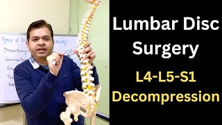 Herniated Disc Surgery Types of Lumbar Disc Surgery L4L5S1 Nerve Compression Microdiscectomy [upl. by Lanor]