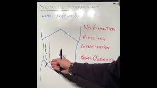 S1E32 Meckel’s Diverticulum [upl. by Orodisi]