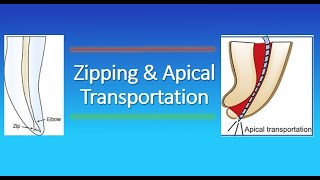 Zipping and Apical Transportation in Endodontics [upl. by Suzie93]