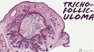 Trichofolliculoma Mother of All Hair Follicles 5Minute Pathology Pearls [upl. by Aikenat445]