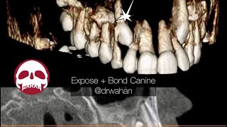 Expose and Bond of a Maxillary Canine Facial Approach [upl. by Jehius]