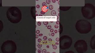 RBC morphology made easy Target cell and its causesred blood cells mlt hematology Iron [upl. by Kirrad]