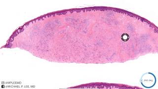 Erythema Elevatnum Diutnem Rare form of vasculitis Dermpath Made Easy [upl. by Little]