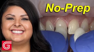 HOW TO Seat NoPrep Veneers for ANTERIOR Teeth 4 13 [upl. by Relyks]