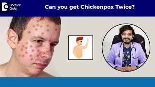 Can you get CHICKENPOX Twice Chickenpox Vaccine amp Treatment DrLeela Mohan P V R Doctors Circle [upl. by Arymat]