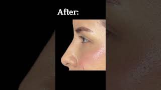 Nonsurgical Nose Job Before and After [upl. by Aicatsanna952]