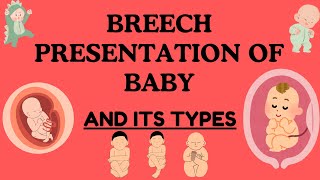 Breech Presentation of Baby Understanding Types Risks and Delivery Options Novice Medic [upl. by Andrus]