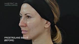 Blanc B  World first anti aging Melasma Filler injection based on Peptides [upl. by Aeki]