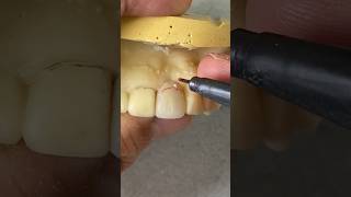 How to add a Single Tooth to a Metal Flipper Partial dental dentist shorts shortvideo tooth [upl. by Victoir]