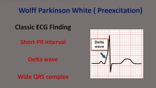 Basic WPW ECG Pattern [upl. by Odnama]