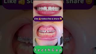 Teeth Gap  Overjet treatment [upl. by Dunc]