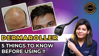 Dermaroller for Hairfall Does It Work  Hair Transplant Clinic  Dadu Medical Centre [upl. by Uranie673]