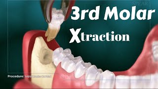 Tricks for Lower 8 third molar wisdomtooth extraction removal with elevator amp forcep Technique [upl. by Oiciruam]