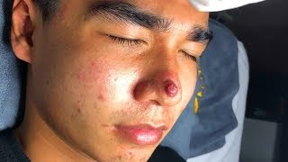 Remove Acne On Face ✦ Dr Laelia ✦ [upl. by Ahtoelc]