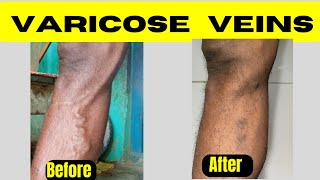 Varicose veins treatment before SSC GD [upl. by Amiarom]