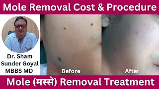 Mole Removal Cost amp Procedure Moles मस्से Removal Treatment [upl. by Lorenza]