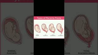 Types of placenta previa implantation  bleeding 🩸knowledge medical shortvideo share [upl. by Refynnej]